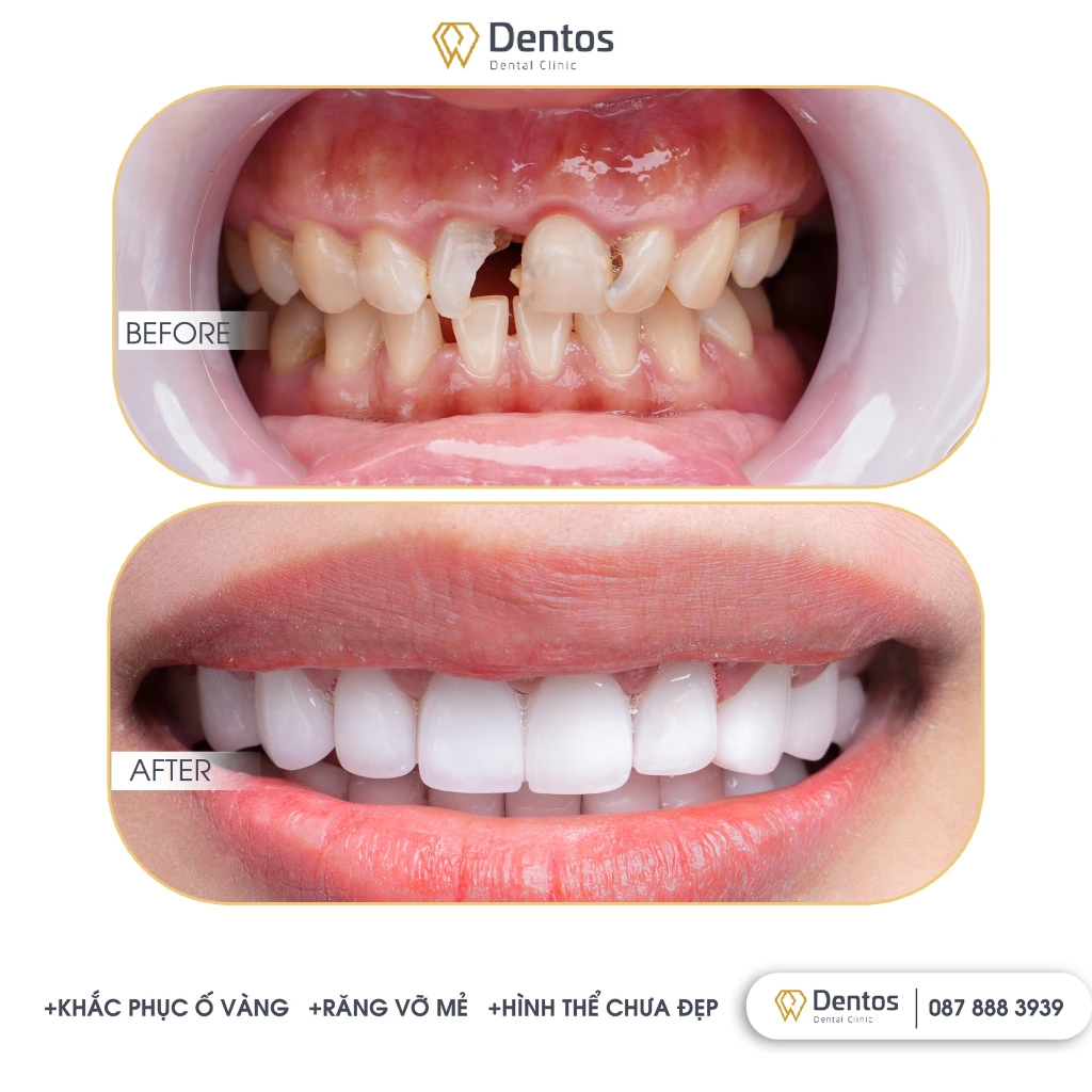 Nên bọc răng sứ khi răng bị mẻ, vỡ để phục hồi chức năng ăn nhai